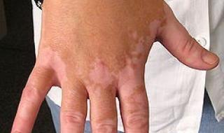 白癜风初期症状图片 白癜风初期症状图片